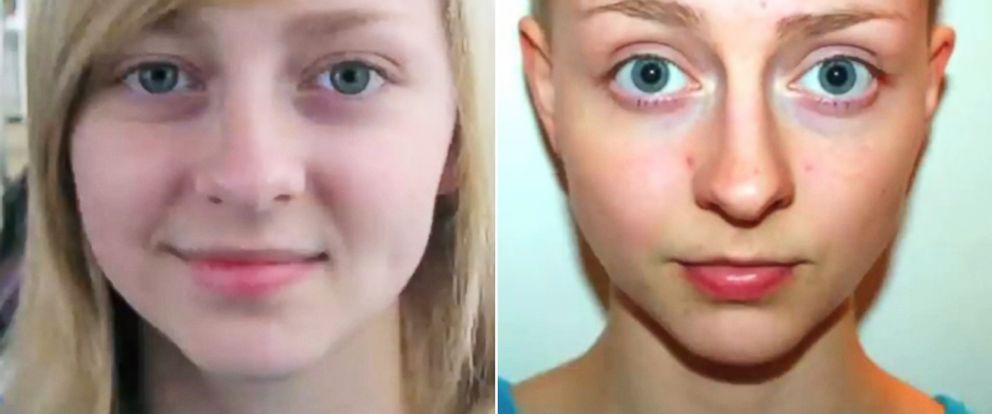 Woman With Hair Loss Condition Trichotillomania Captures Transformation