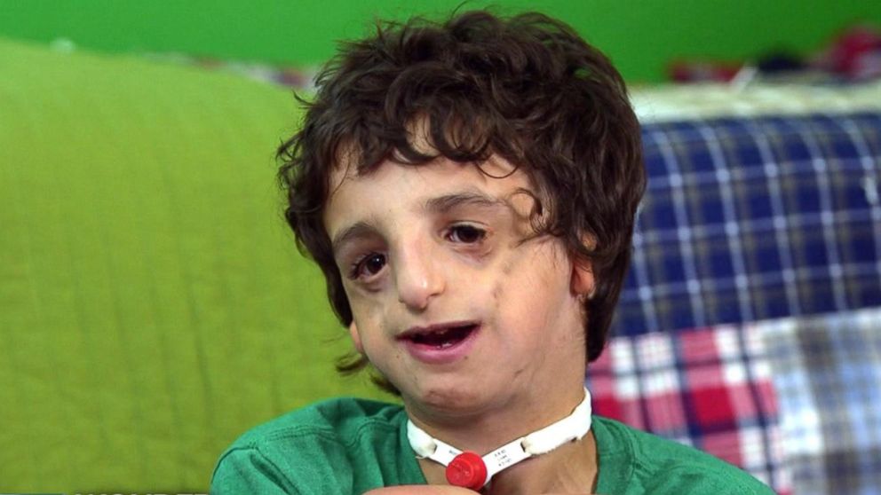 Boy living with Treacher Collins has 53 surgeries by age 11: Part 2