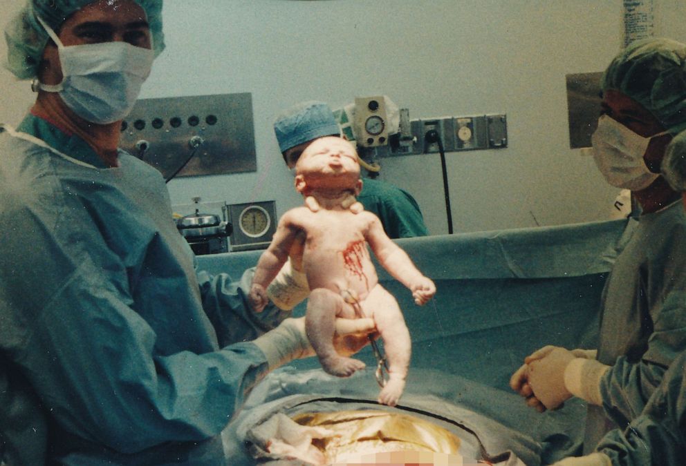 PHOTO: Dr. Kim McMorries, who runs a fertility clinic in Nacogdoches, Texas, holds Eve in the delivery room in 1987.