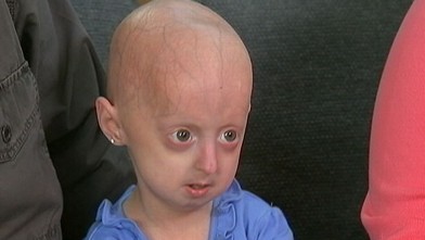 Hope Grows For Girl With Rare Rapid Aging Disease Progeria Video
