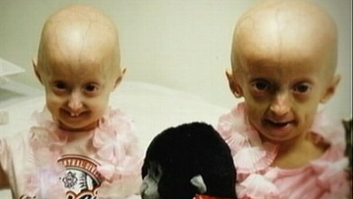 Hope Grows for Girl With Rare Rapid-Aging Disease Progeria Video - ABC News