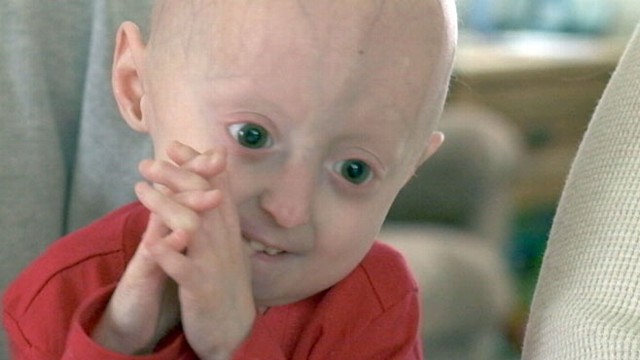Children Living With Progeria Inside Their World Abc News