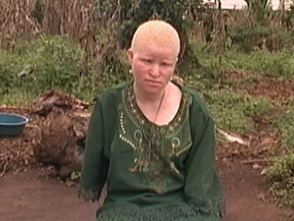 Tanzanians with Albinism Hunted