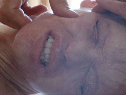 VIDEO: Parents of burned model rub her scars with lotion as part of skin regimen.