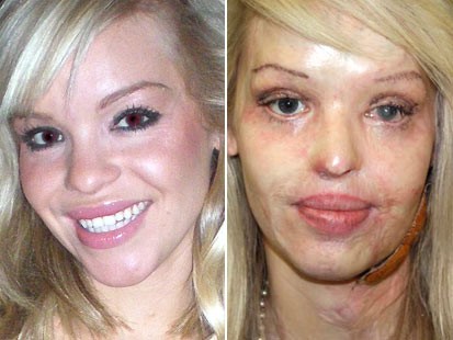 Katie Piper British Model Burned In Sulfuric Acid Attack ABC News   Ht Katie Piper 100105 Ms 