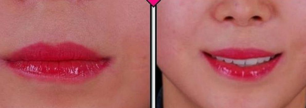 Joker Lips Surgery In South Korea Creates Perma Smile Abc