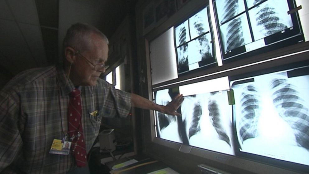 Dr. Paul Wheeler of Johns Hopkins examines lung X-rays.