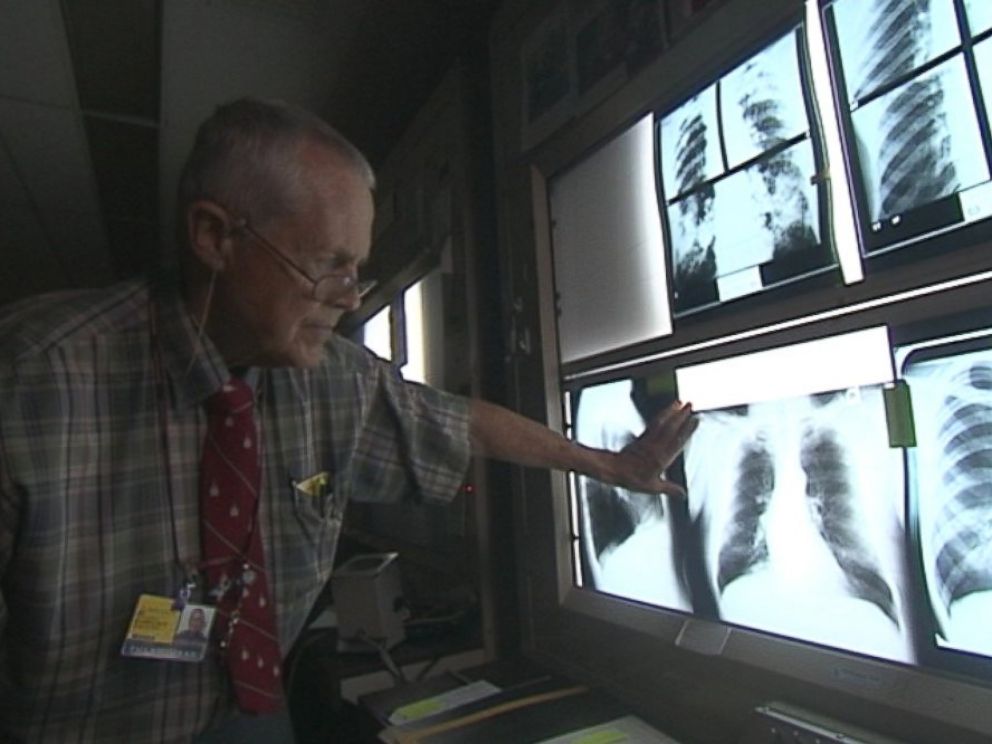 PHOTO: Dr. Paul Wheeler of Johns Hopkins examines lung X-rays.