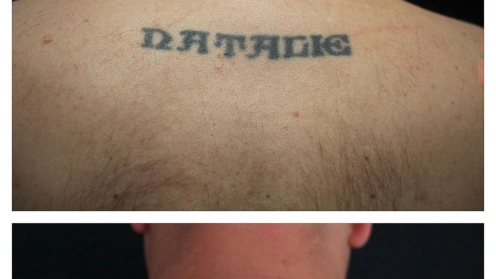 This combination of undated photos provided by Dr. Paul Friedman in July 2019 shows the back of patient Ryan Tucker before and after a series of laser tattoo removal procedures in Houston. Friedman, a spokesman for the American Society for Dermatolog