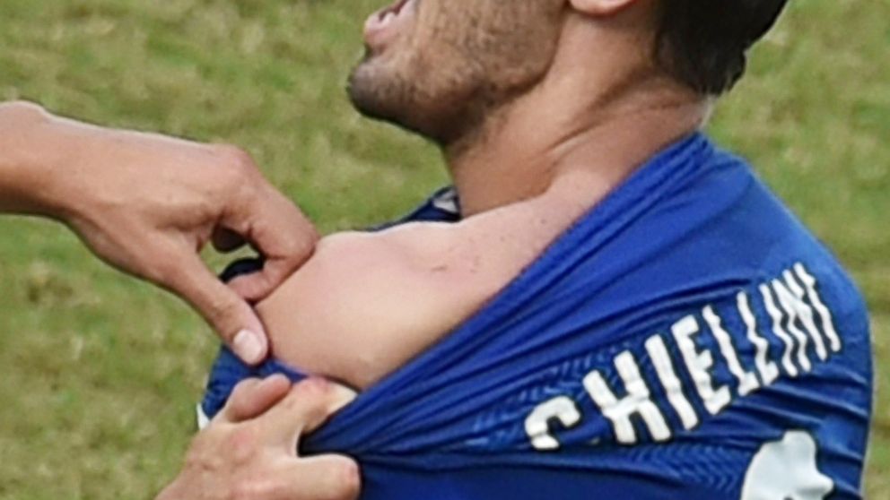 PHOTO: Italy's defender Giorgio Chiellini shows an apparent bitemark by Uruguay forward Luis Suarez during soccer match between Italy and Uruguay in Natal during the 2014 FIFA World Cup on June 24, 2014.
