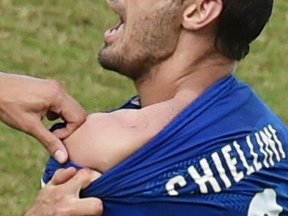 PHOTO: Italy's defender Giorgio Chiellini shows an apparent bitemark by Uruguay forward Luis Suarez during soccer match between Italy and Uruguay in Natal during the 2014 FIFA World Cup on June 24, 2014.