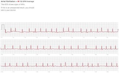 apple watch ecg examples