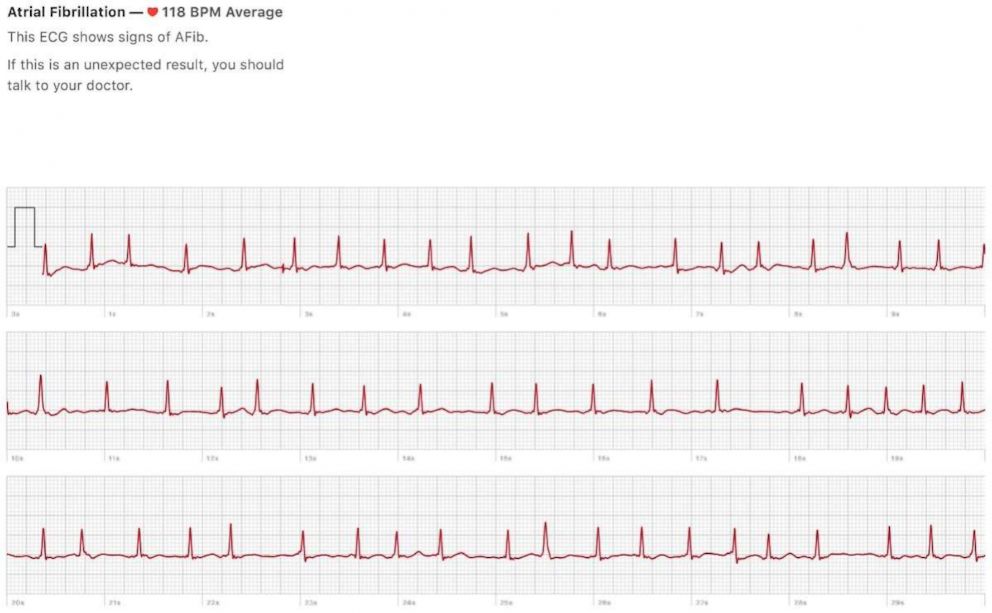 Normal apple watch ecg new arrivals