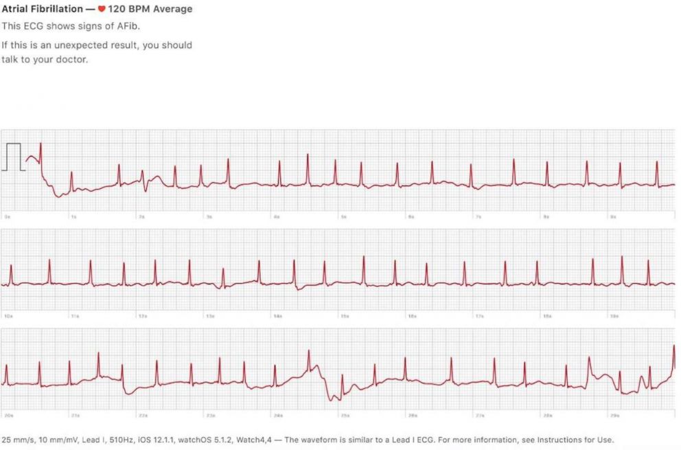 PHOTO: Ed Dentel received an alert from his Apple watch about an abnormal heart rate.