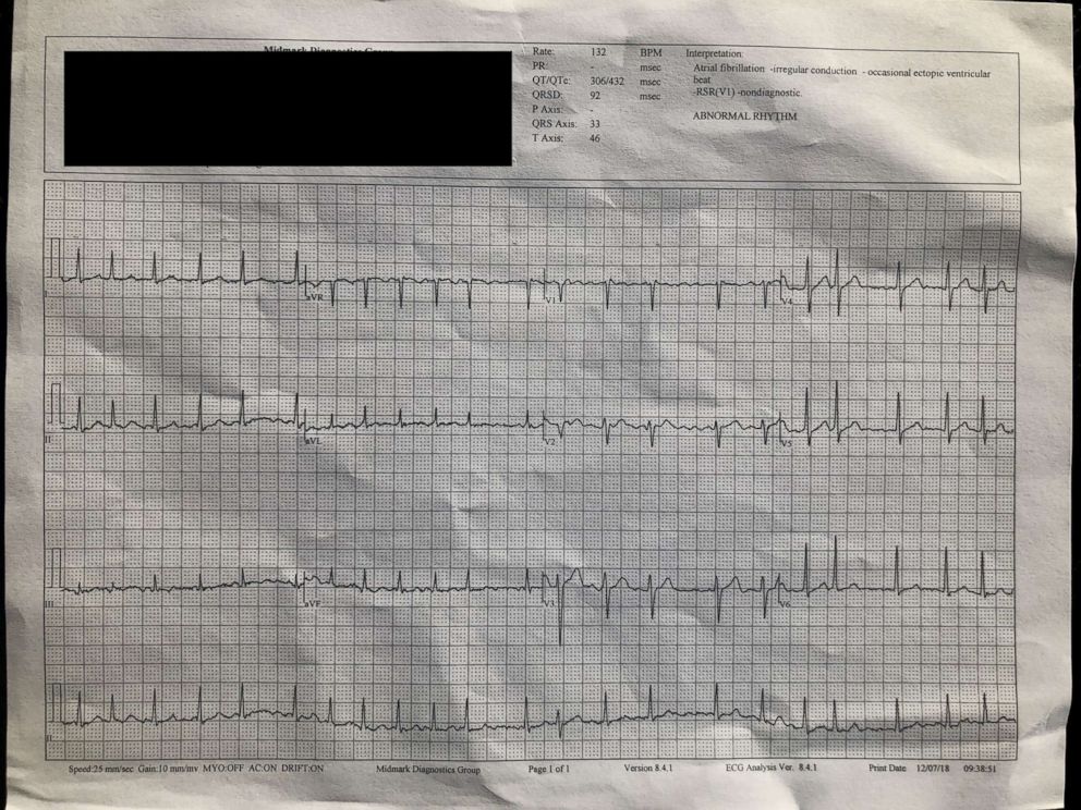PHOTO: Ed Dentel's EKG after getting tested following an alert from his Apple watch.