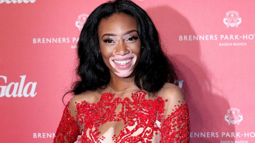 Model Winnie Harlow, aka Chantelle Winnie, during the Gala Spa Awards 2015 at Brenners Park-Hotel & Spa, March 21, 2015, in Baden-Baden, Germany.