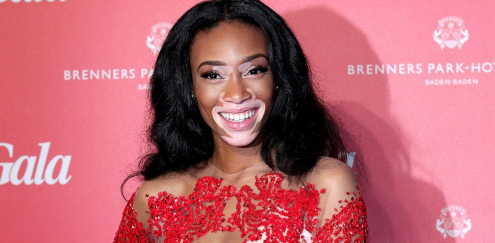 Model Winnie Harlow In Middle Of Debate About Blackface Abc News