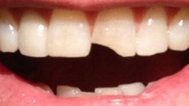 PHOTO: Jim Careys teeth