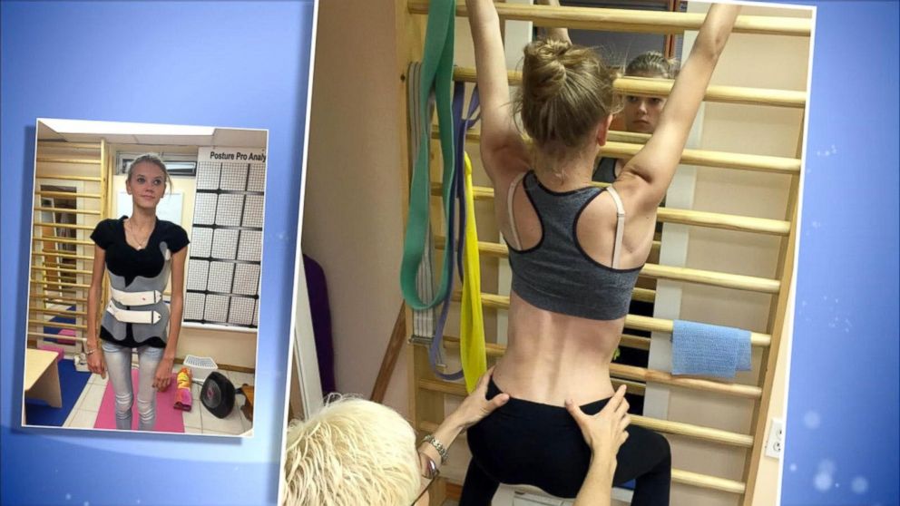 PHOTO: Anastasia Machenko, 17, was diagnosed with scoliosis, a disorder in which there is a sideways curve of the spine, according to the National Institutes of Health.