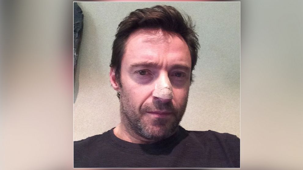 PHOTO: Actor Hugh Jackman posted this photo on his Instagram account on Nov. 21, 2013 with the caption, "Deb said to get the mark on my nose checked. Boy, was she right! I had a basil cell carcinoma."
