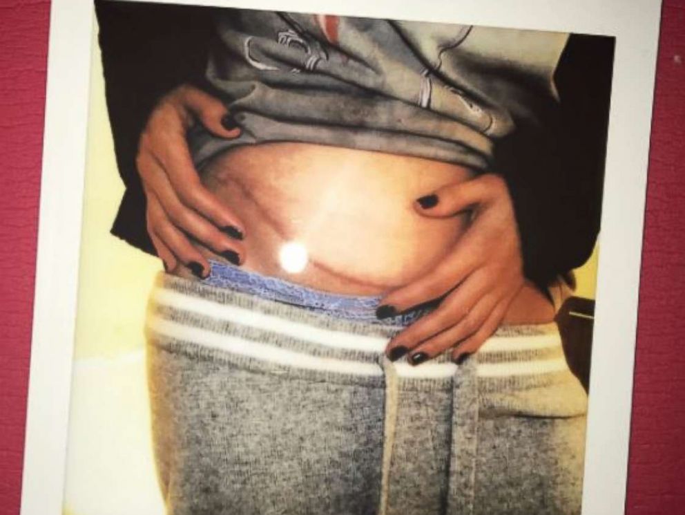 PHOTO: Selena Gomez, 25, announced in a series of photos that she is recovering after receiving a kidney transplant.
