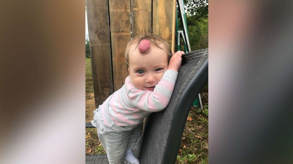 PHOTO: Chloe McKnight was born with a hemangioma on the top of her forehead. 