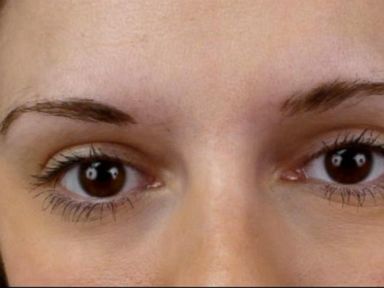 VIDEO: Women Turn to Eyebrow Transplants for Fuller Brows