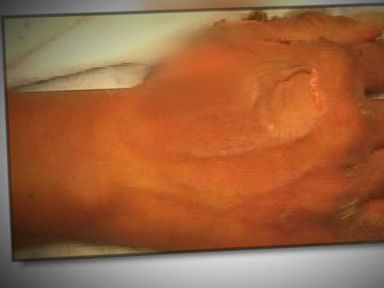 VIDEO: Woman Allegedly Fakes 2nd Degree Burns From McDonald's Coffee