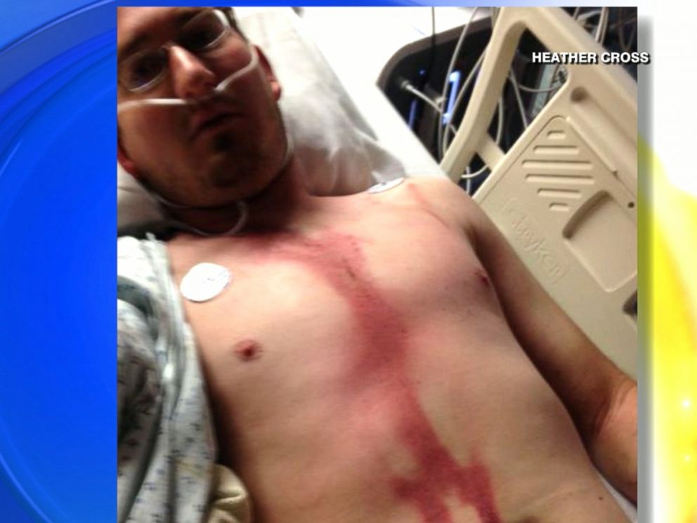 Man Survives Lightning Strike to the Head During Memorial Day Weekend  Outing - ABC News