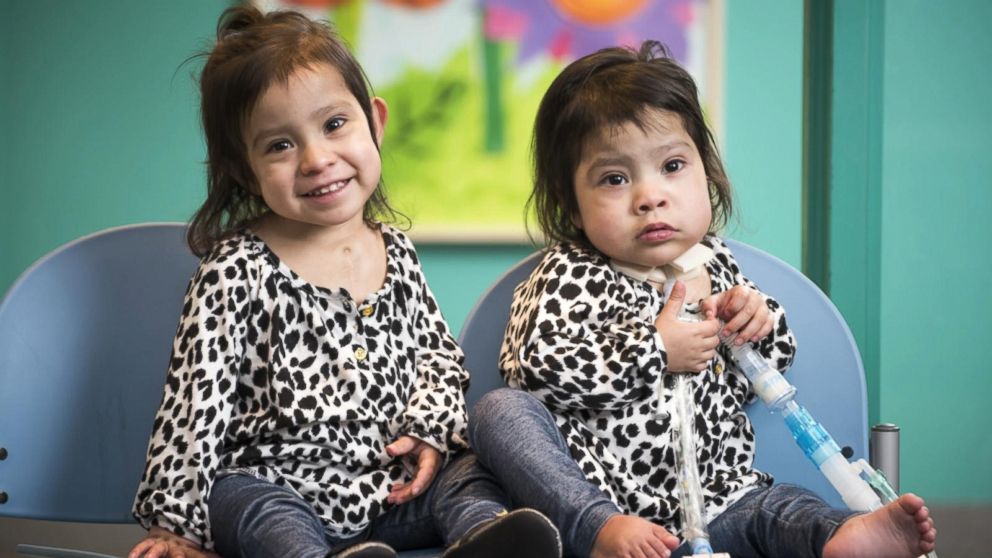 Formerly Conjoined Texas Twins Thriving Year After Separation Video