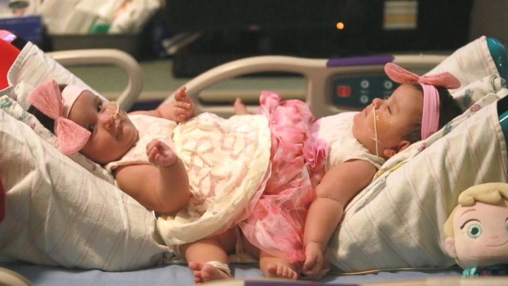 Texas Conjoined Sisters Successfully Separated Video Abc News 2749