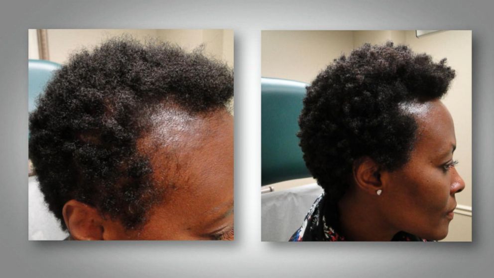 Minoxidil 5% Hair Growth Serum Oil Biotin Hair Regrowth Treatment for Scalp Hair  Loss Hair Thinning, Hair Growth Serum for Men Women 1 fl.oz Black
