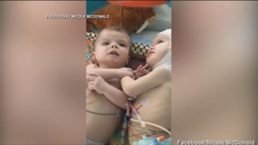 Conjoined twins opened up on what their life was like after