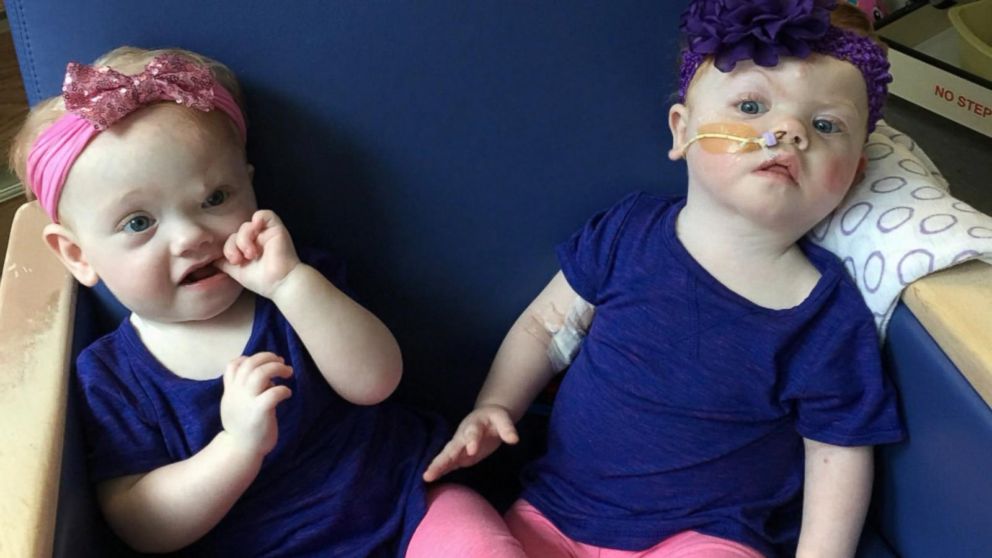 Family shares update on formerly conjoined twins following separation