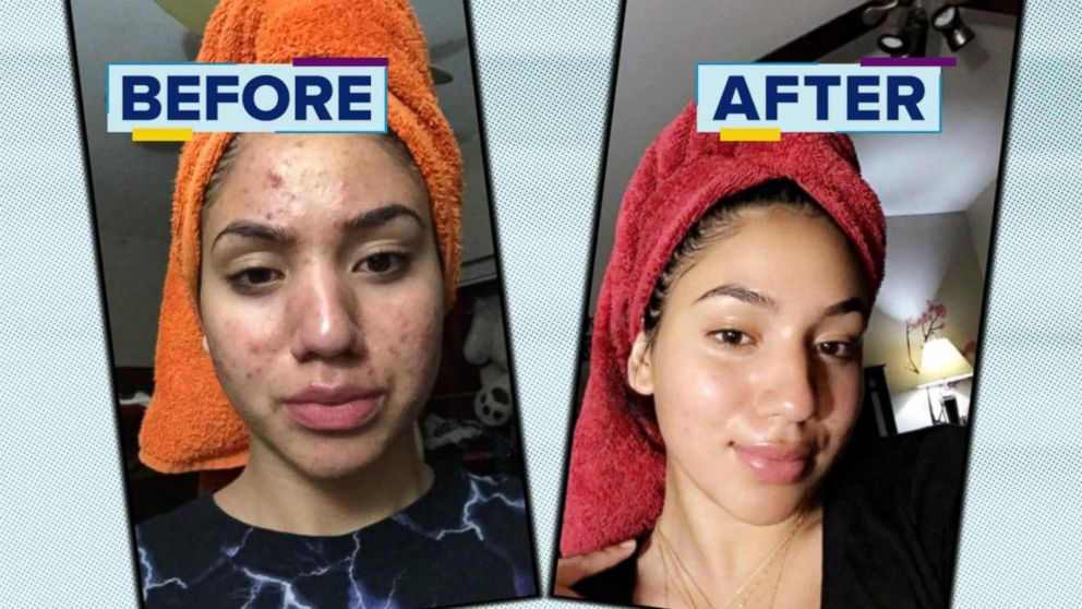 992px x 558px - How a teen cleared her acne using cheap products