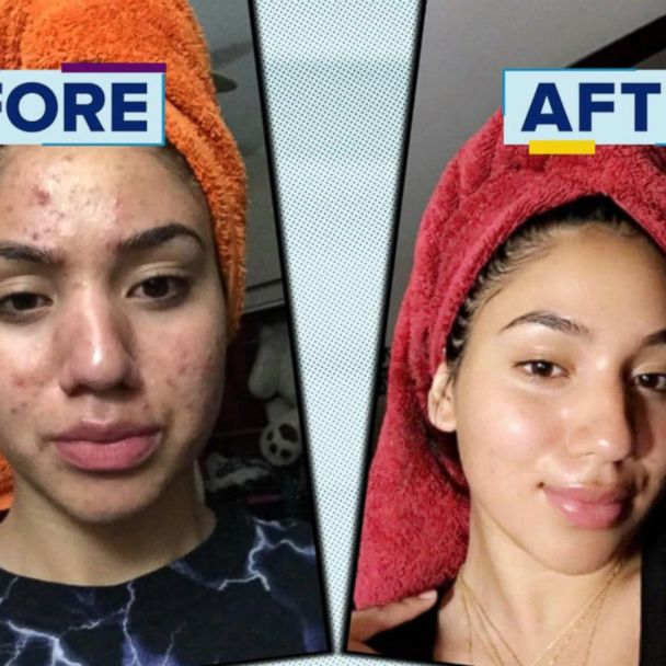 How our CEO Cured her Acne at Home