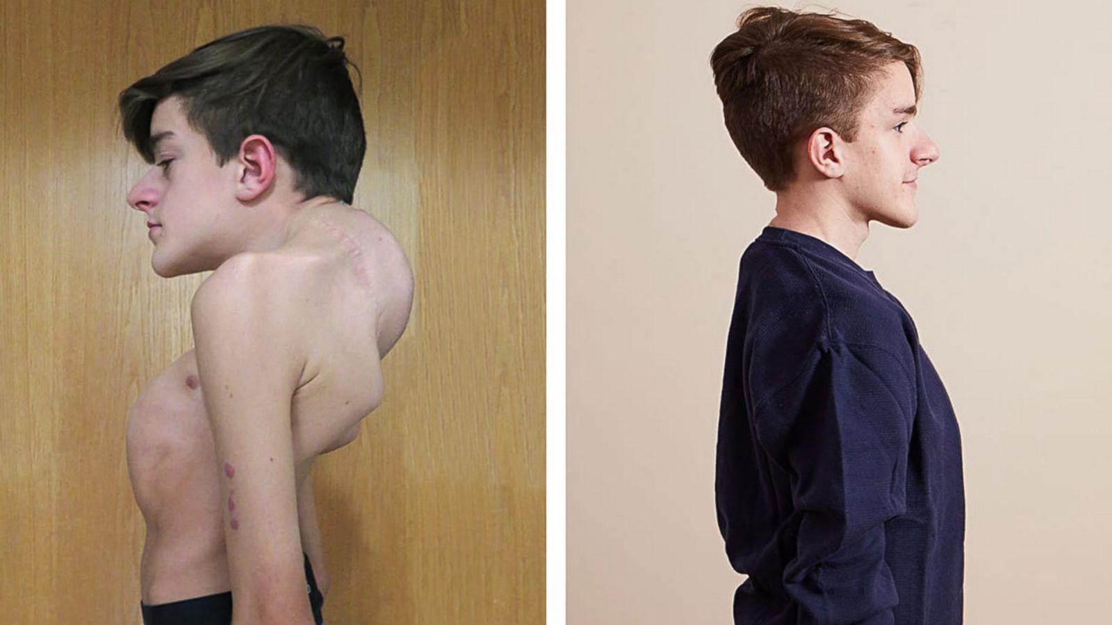 VIDEO: 19-year-old has miraculous recovery after battling severe scoliosis