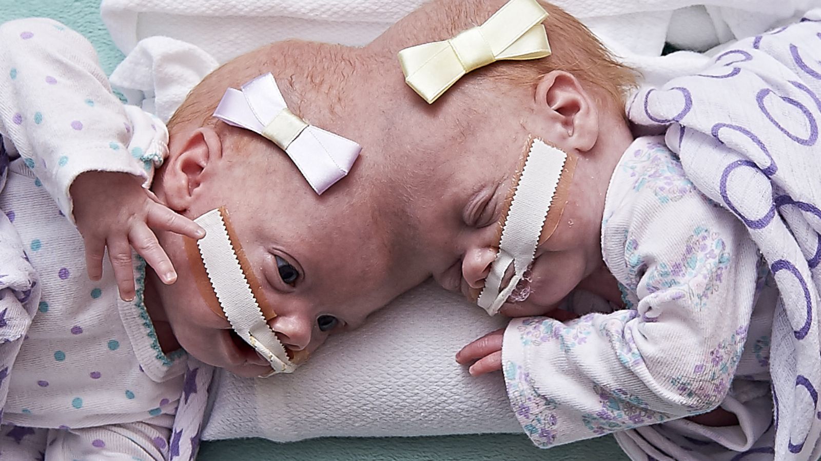 VIDEO: Once-conjoined twins are now thriving toddlers