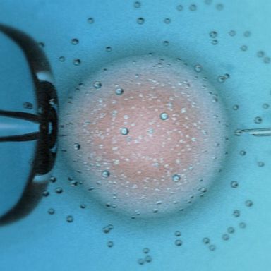 VIDEO: New study looks at the link between IVF and child cancer