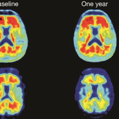 VIDEO: New study may be shedding light on whether anti-inflammatory drugs can prevent Alzheimer's