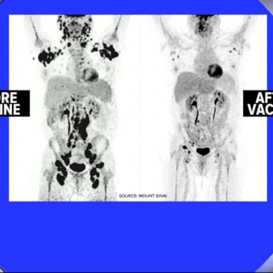 VIDEO: What to know about the new lymphoma vaccine 