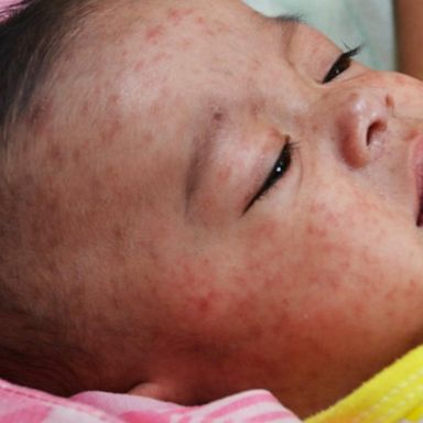 VIDEO: Measles outbreak now worst in US in nearly 20 years