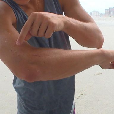 VIDEO: Surfer's shark bite caught on camera off Florida coast 