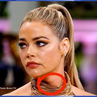 VIDEO: Denise Richards treats an enlarged thyroid after fan noticed it on TV