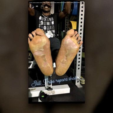 VIDEO: Football star sidelined after frostbite from cryotherapy