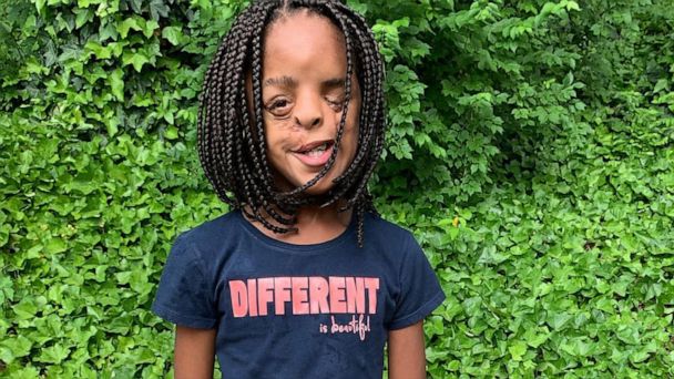 11-year-old girl teaches valuable lesson about embracing what makes your  different - Good Morning America