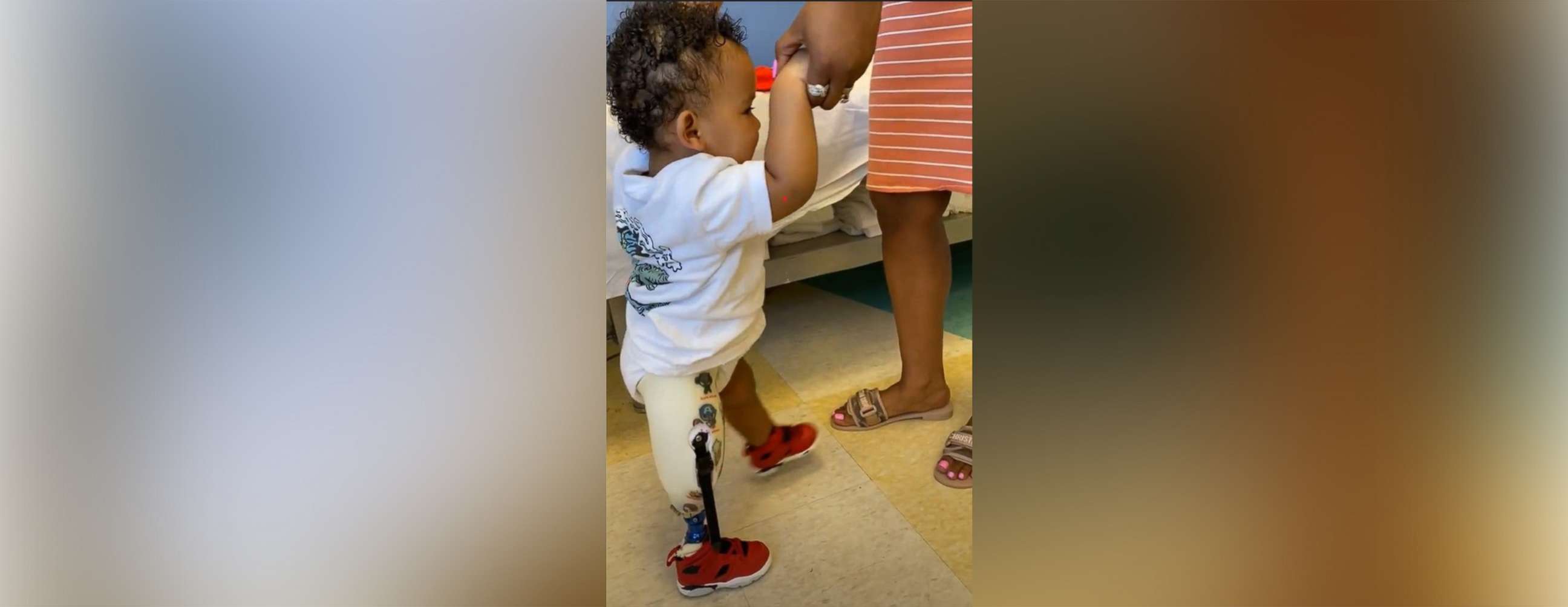 PHOTO: Dakari Miranda, of Chicago, was born with tibial hemimelia and had his right leg amputated shortly after his first birthday.