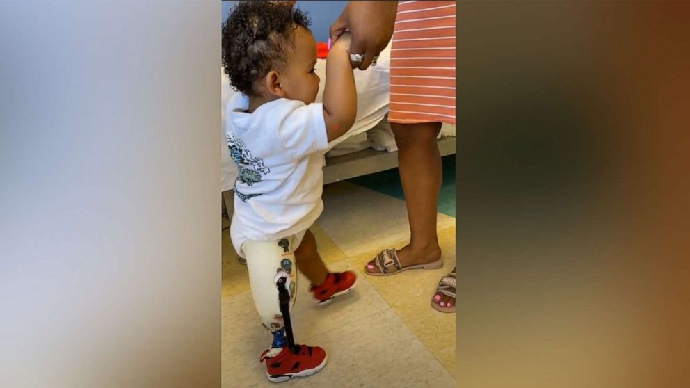 PHOTO: Dakari Miranda, of Chicago, was born with tibial hemimelia and had his right leg amputated shortly after his first birthday.