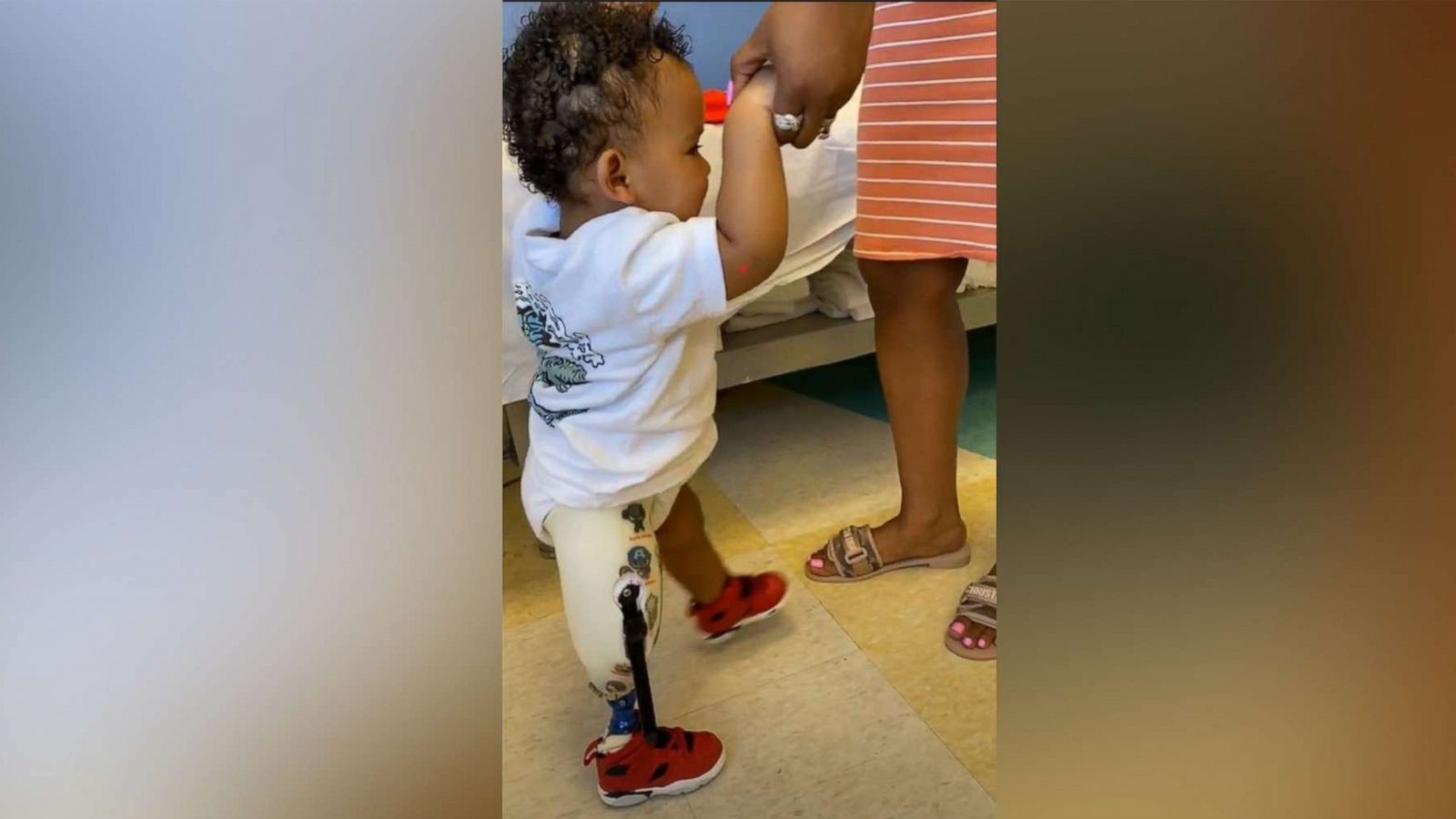 PHOTO: Dakari Miranda, of Chicago, was born with tibial hemimelia and had his right leg amputated shortly after his first birthday.