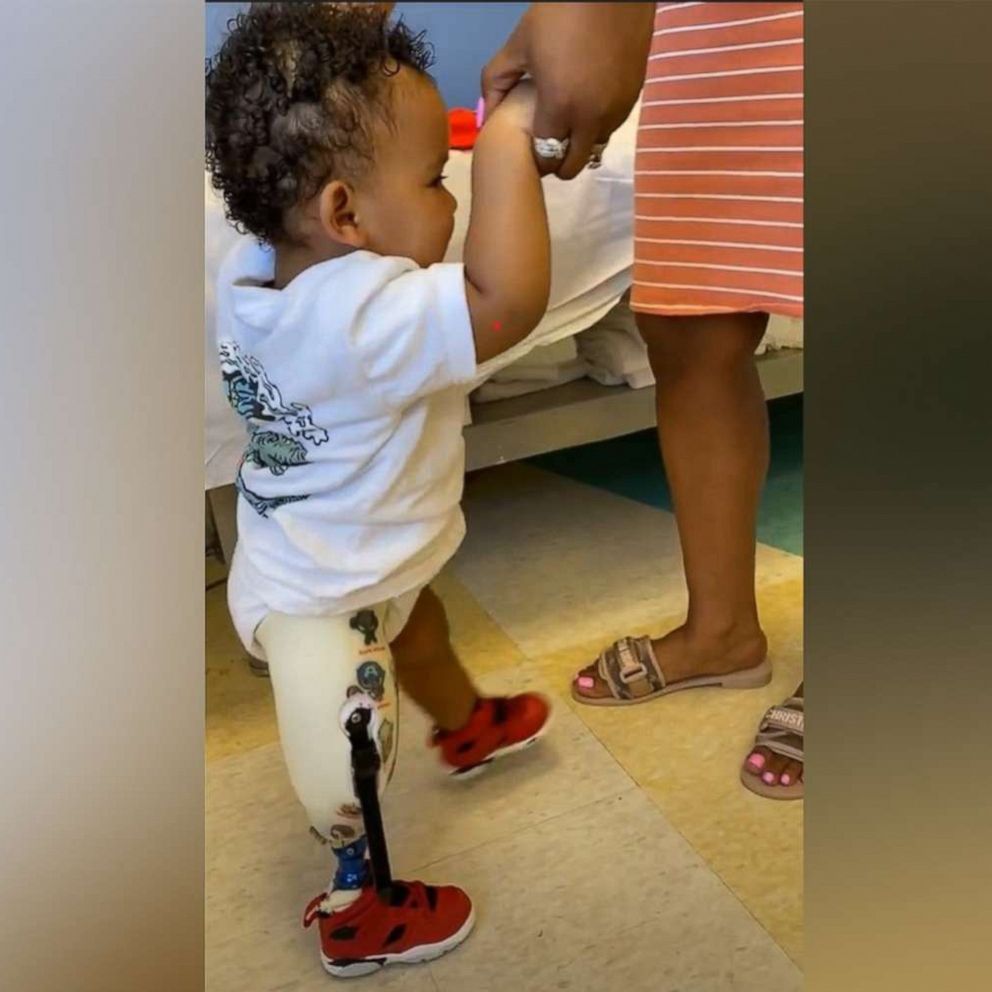 VIDEO: Boy born with incredibly rare condition gets prosthetic leg